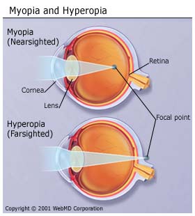 myopia-and-hyperopia